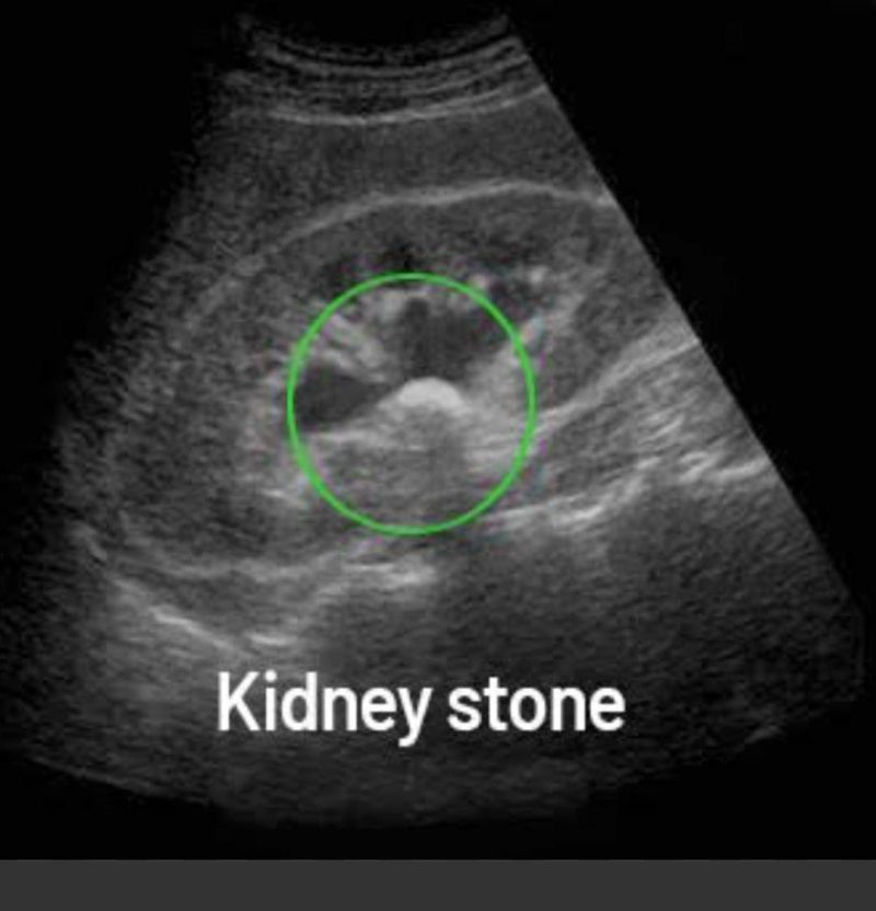 سونوگرافی برای تشخیص سنگ کلیه