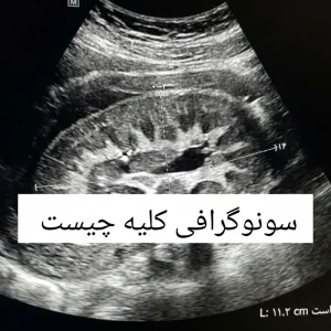 سونوگرافی کلیه چیست؟ آشنایی با کاربرد‌های سونوگرافی کلیه