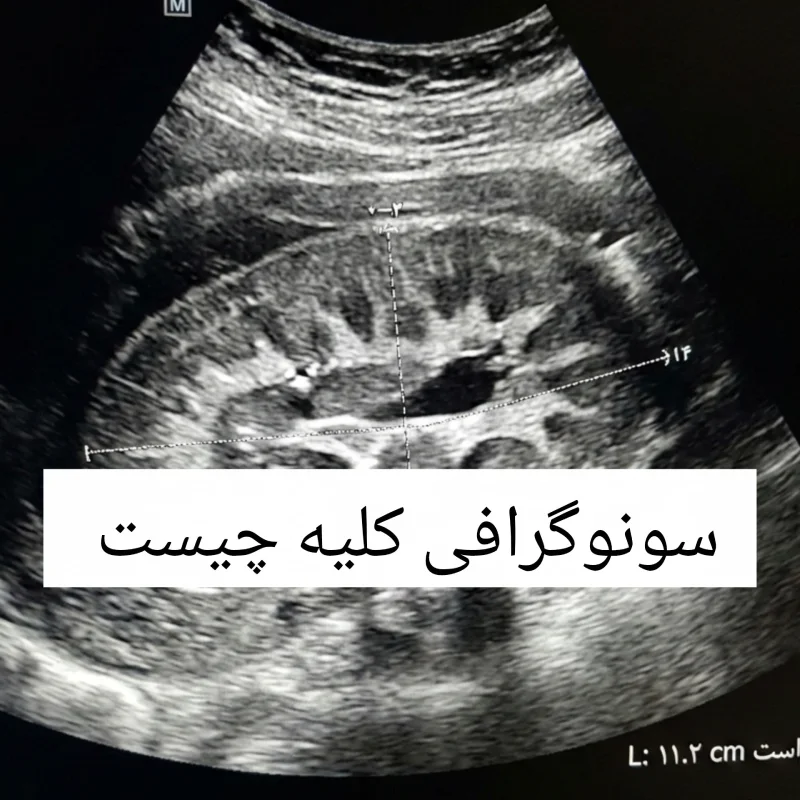 سونوگرافی کلیه چیست؟ آشنایی با کاربرد‌های سونوگرافی کلیه