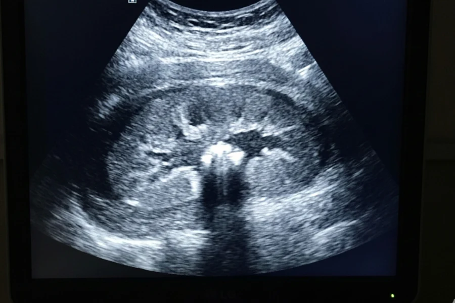 تشخیص سنگ کلیه با سونوگرافی کلیه