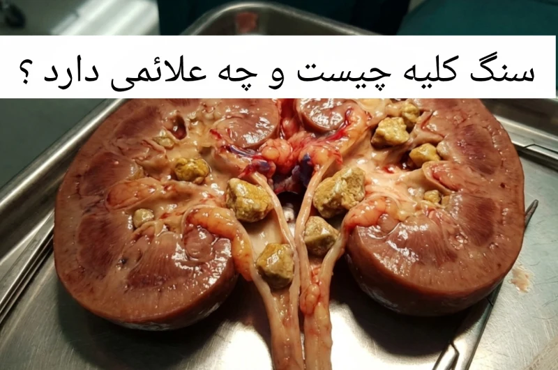 سنگ کلیه و علائم آن را بشناسید
