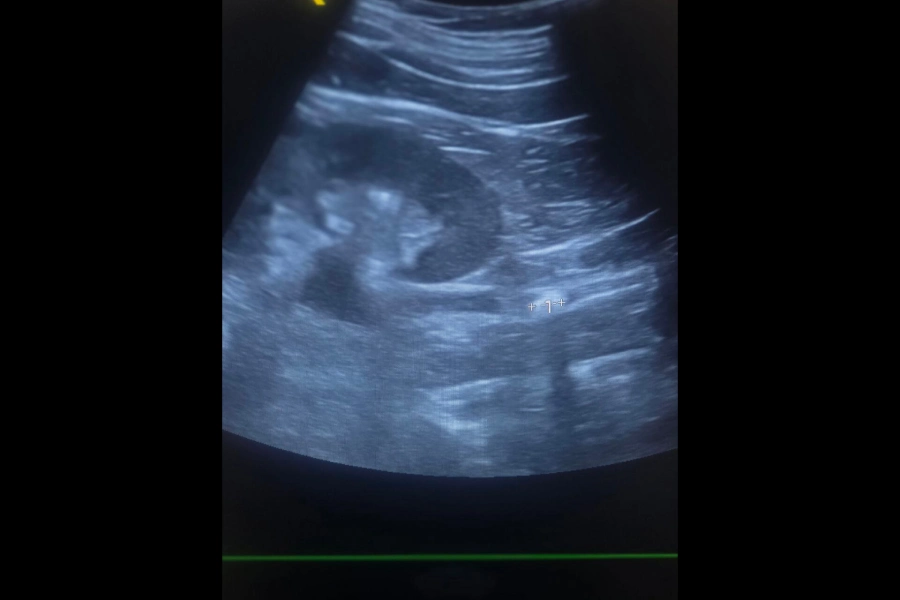 سنگ گیر کرده در حالب