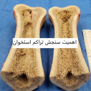 چرا سنجش تراکم استخوان اهمیت دارد؟ افراد در معرض خطر پوکی استخوان بخوانند