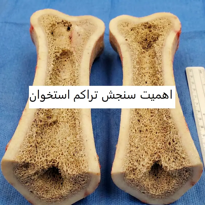 چرا سنجش تراکم استخوان اهمیت دارد؟ افراد در معرض خطر پوکی استخوان بخوانند