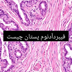 با علائم و روش های تشخیص فیبرآدنوم پستان آشنا شوید