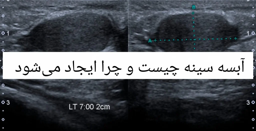 با علائم، عوارض و روش درمان آبسه سینه آشنا شوید