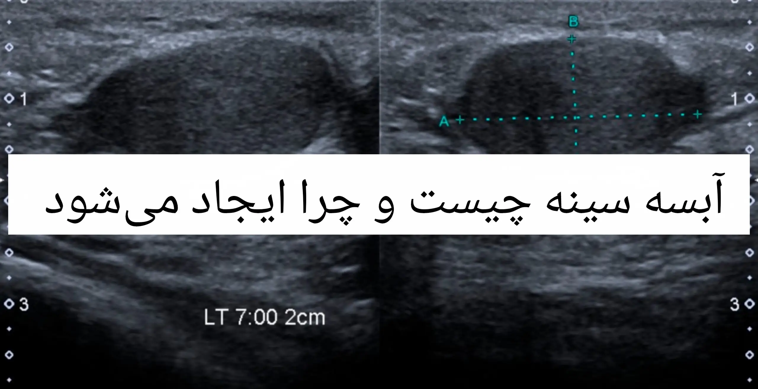 با علائم، عوارض و روش درمان آبسه سینه آشنا شوید