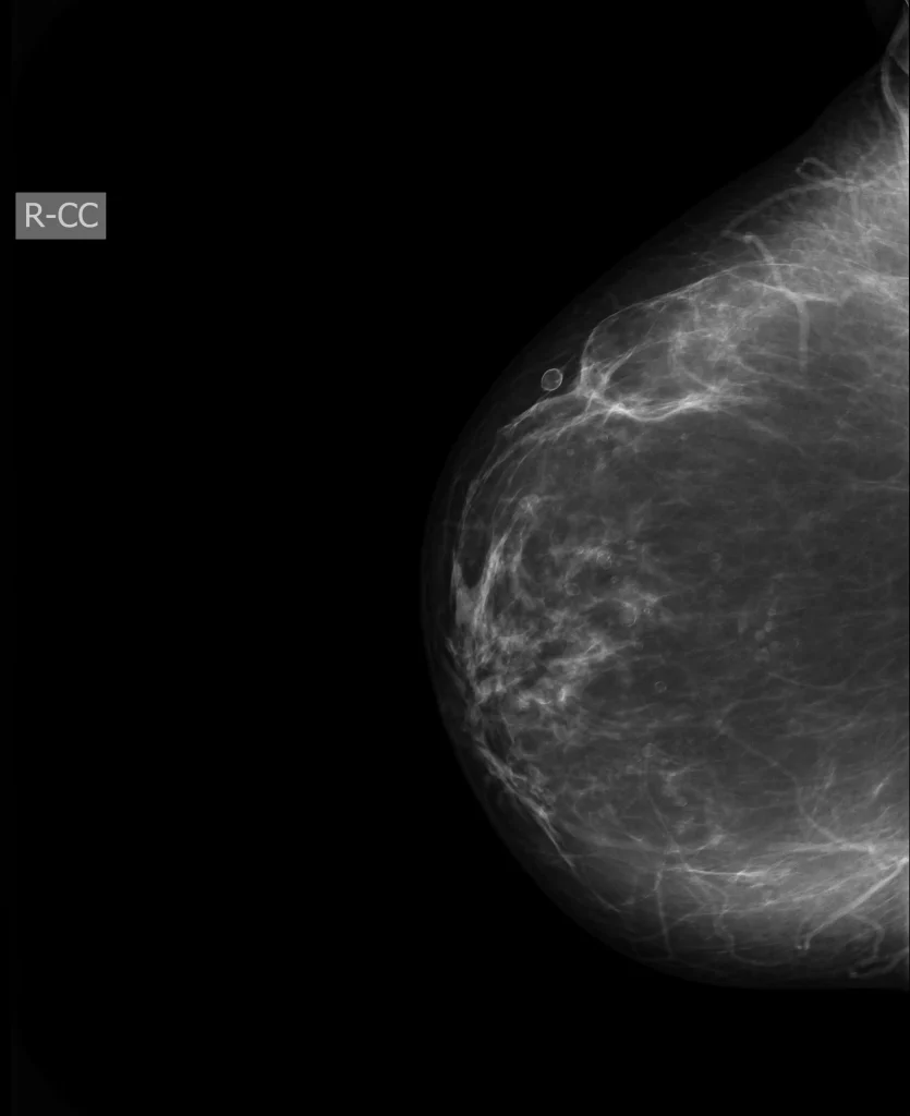 روشهای تشخیص آبسه سینه