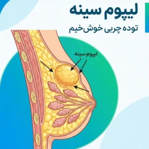 با لیپوم سینه و عوارض آن آشنا شوید!